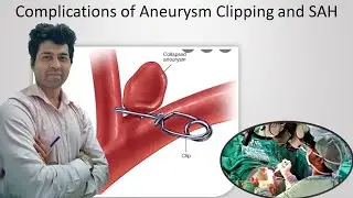 Complications of Brain Aneurysm clipping and SAH. Explained by Dr Skanda Neurosurgeon