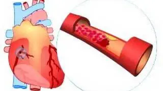 What causes a heart attack?