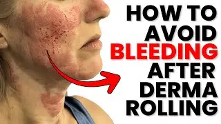 REDNESS, FLAKING, BLEEDING, AND DRY SKIN AFTER MICRONEEDLING: WHAT'S NORMAL AND WHAT'S NOT