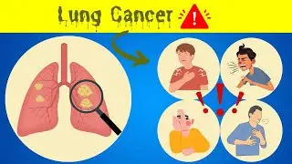 Lung Cancer Symptoms: The Silent Enemy Revealed