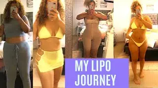 LIPOSUCTION BEFORE AND AFTER : My experience with plastic surgery!  Includes before & after pictures