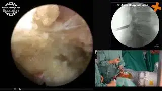 Spinal decompression at L4-L5 performed with full-endoscopic interlaminar approach.