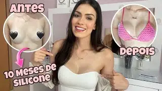 DIÁRIO DO SILICONE: 10 MESES DE CIRURGIA - Um Seio Ficou Maior Que o Outro? Estria? Dei Queloide?