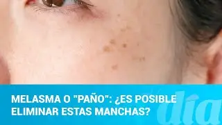 Melasma o 