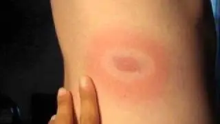 Lyme focused discussion utilizing zyto and pulsed technologies