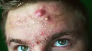 EVERY ACNE SUFFERER NEEDS TO SEE THIS | How To Get Past the Insecurity!