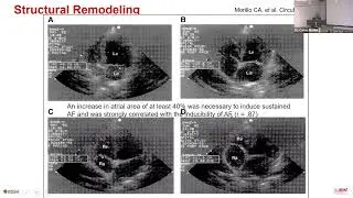 Atrial Fibrillation: From Bench to Bedside and Beyond: A Personal Perspective