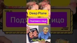 Deep plane подтяжка лица. Топ подтяжка лица. #пластическийхирург #подтяжкалица
