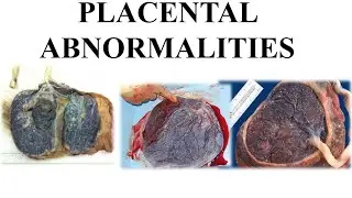 Placental Abnormalities