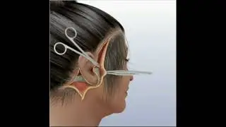 3D Simulation of Full Face Lift and Neck Lift | Dr. Thai at Viet My Plastic Surgery Hospital