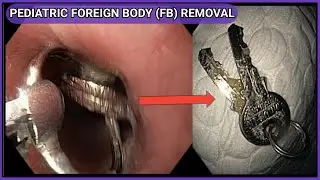 Pediatric Foreign Body Removal Of Keys  l ফরেন বডি রিমুভাল #BD_ENDOSCOPY