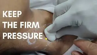 Removing a Hemodialysis Catheter (A How-To Guide for Patients) #catheter #catheterremoval #dialysis