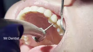 Interdental Tooth Decay - COMPOSITE TOOTH FILLING  !!!!!