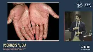 Actualización en Psoriasis 2019 - Dr. Pablo de la Cueva 
