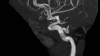 Persistent Trigeminal Artery