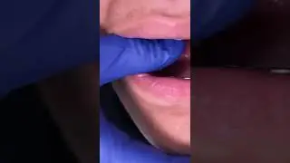 Palatal Expanders- 15 year old patient - Upper RPE plus Expander and Lower Expander - Toothtime