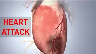 What is a HEART ATTACK?