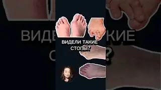 КОСТОЧКА НА СТОПЕ - ЧЕМ ЛЕЧИТЬ?