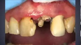 Clinical Tip: Glass Fiber as an emergency saver by Dr Kaminer