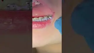 Do Power Chains For Braces Hurt - Tips for Pain Relief - Braces New Braunfels Texas Toothtime