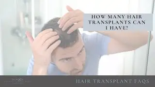 How many hair transplants can I have?