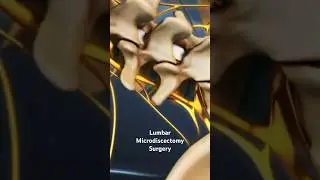 Lumbar Microdiscectomy Surgery