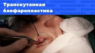 Операция: нижняя транскутанная блефаропластика