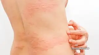 Urticaria por frío: signos y cómo reconocer su presencia