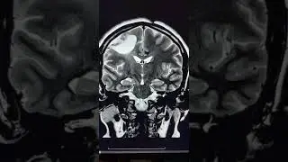 Wallerian degeneration of Corticospinal tract