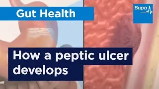 How a peptic ulcer develops | Bupa Health