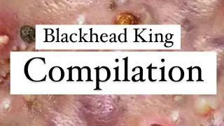 Most Popular Cysts!  Least Popular Pimples!  Mr. Blackhead's Hulking Pops