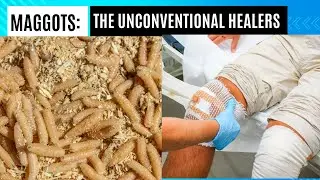 Maggots: The Unconventional Healers