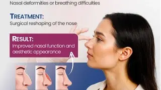 Septo-rhinoplasty for Deviated Nasal septum (DNS) hump reduction- Surgical plan and step’s explained