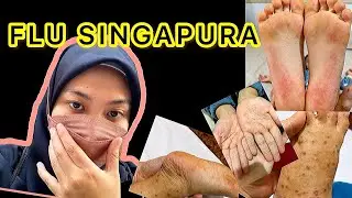 KEDUA ANAKKU KENA FLU SINGAPURA, KUKIRA SCABIES TERNYATA RUAM HMFD (Hand, Mouth, Foot Desease)