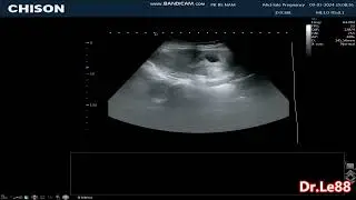 thai bám vị trí sẹo mổ cũ ???