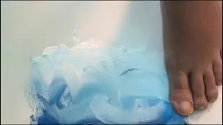 Kondromalazi Patella