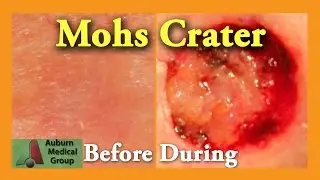 Mohs Surgery: Part 1 | Auburn Medical Group