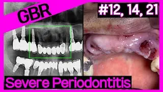[Online Surgery] Implant therapy after socket preservation for maxillary anterior teeth