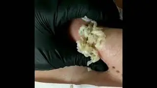 Выдавили гной.