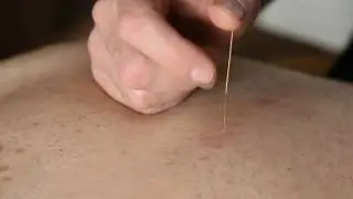 Иглотерапия Чжень Цзю в Традиционной Китайской Медицине
