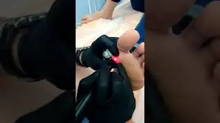 Удаление бородавки в клинике "Асклепион" 1
