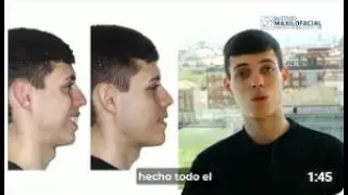Cirugía bimaxilar Caso #145: Joaquin - Retrusión maxilo-mandibular, Apnea del sueño