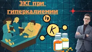 ЭКГ при гиперкалиемии [самое лучшее объяснение]. ECG in hyperkalemia [the best explain].