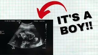 What decides the sex of a baby | Medicines to conceive a baby boy