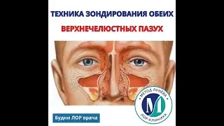 Лечение гайморита.