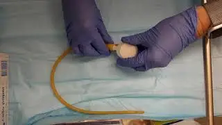 Chyme reinfusion nutritional management for enterocutaneous fistula: a novel pump technique