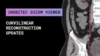 Curvilinear reconstruction updates in Inobitec DICOM Viewer Pro