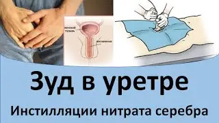 Зуд в уретре.  Инстилляции нитрата серебра