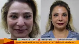 Burun Estetiği Hiç Ağrım Ve Morluk Olmadı !
