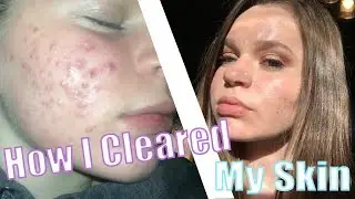 How I Cleared My Skin!